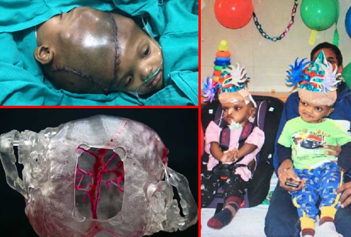 aiims 125 doctors daily practice on 3d head before separation of odisha brothers attach from head