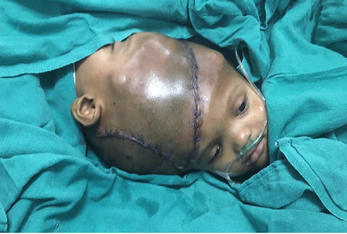 Two Children found new life after a historical surgery of 3D heads in AIIMS