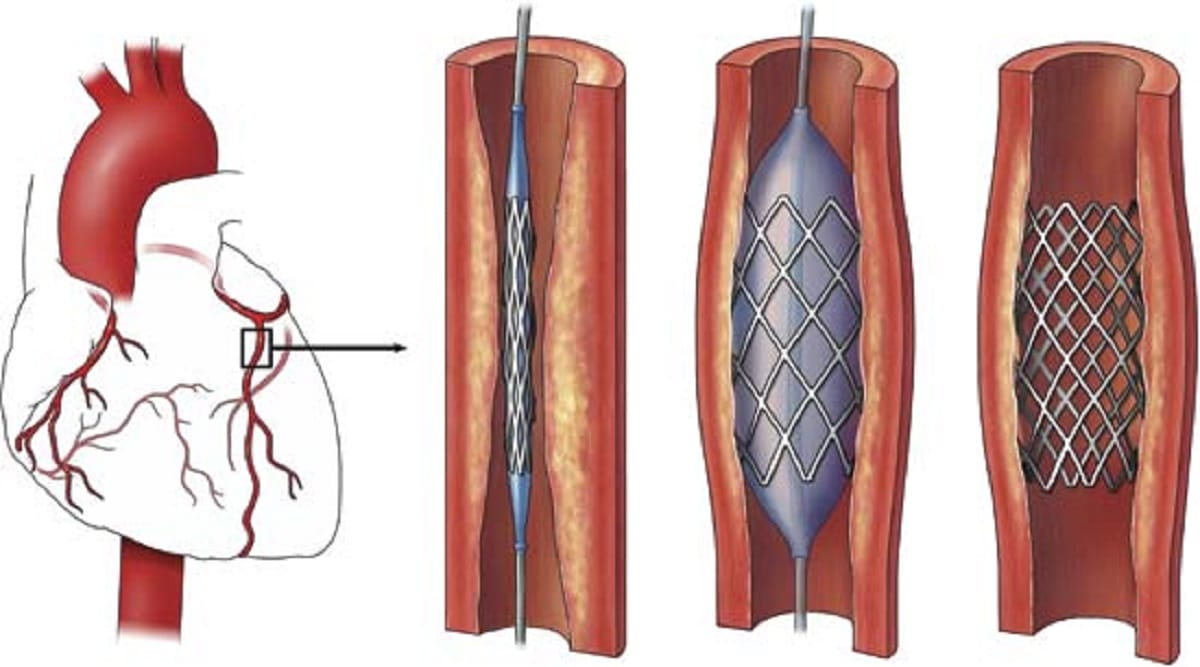 NPPA revised the price of drug eluting stents 