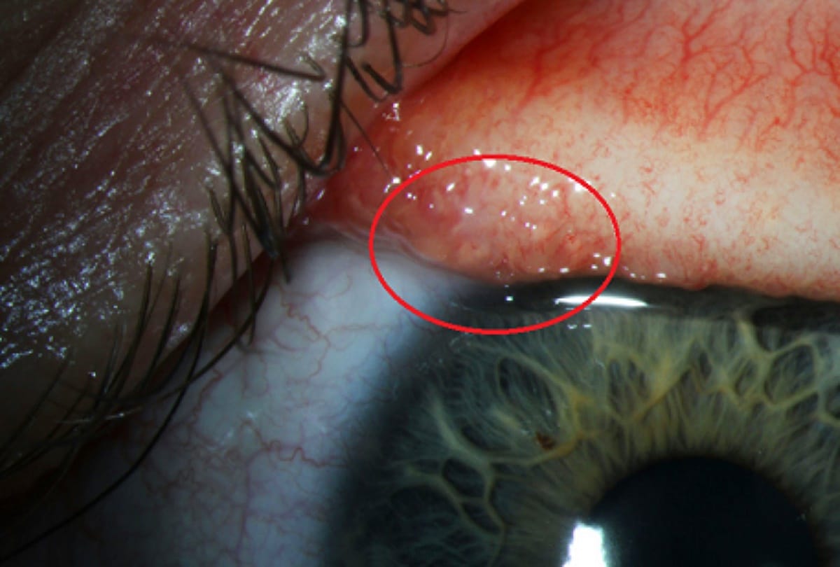 Fourteen worms found in a woman eye