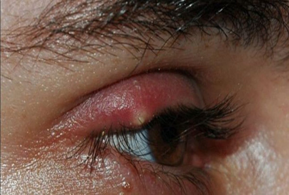 Fourteen worms found in a woman eye