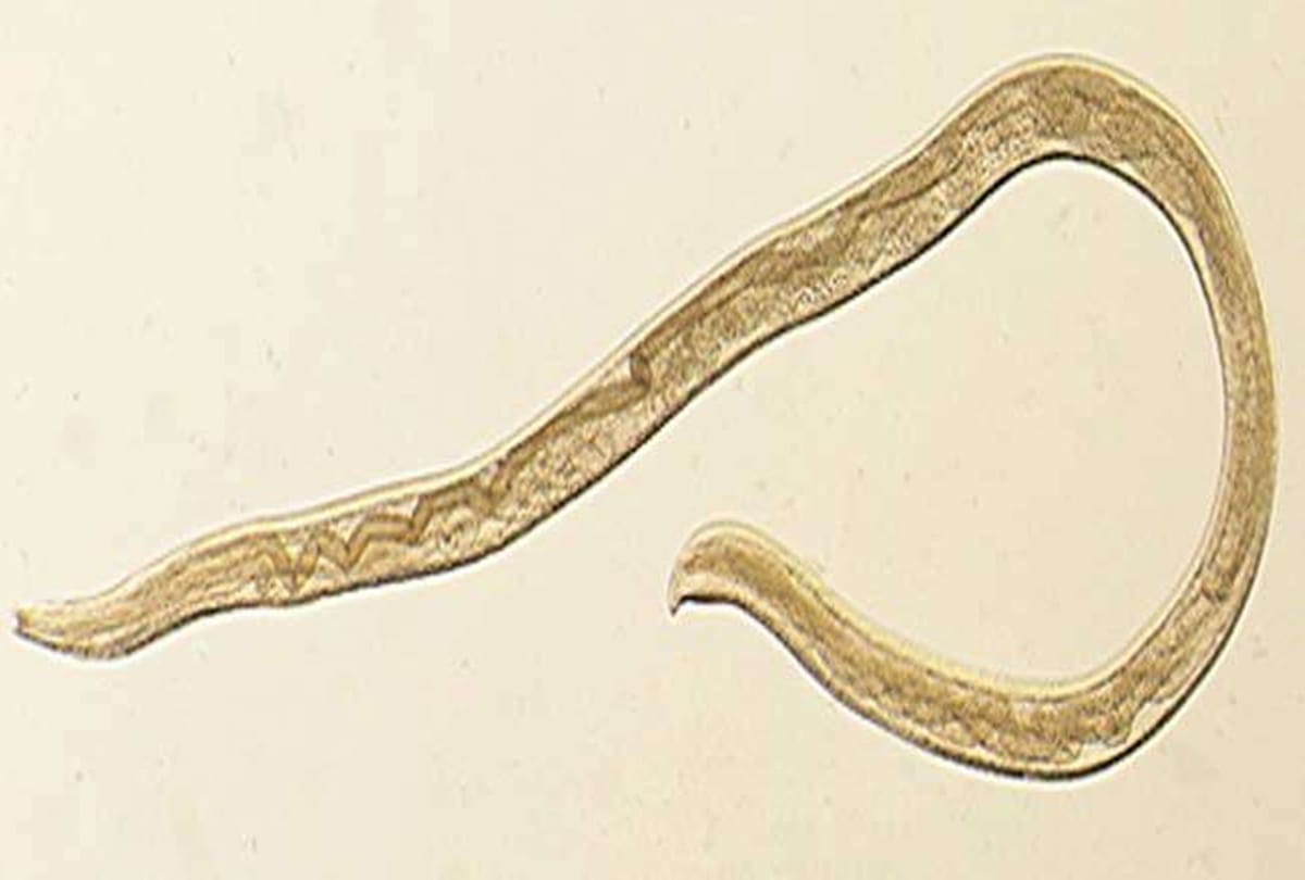 Fourteen worms found in a woman eye
