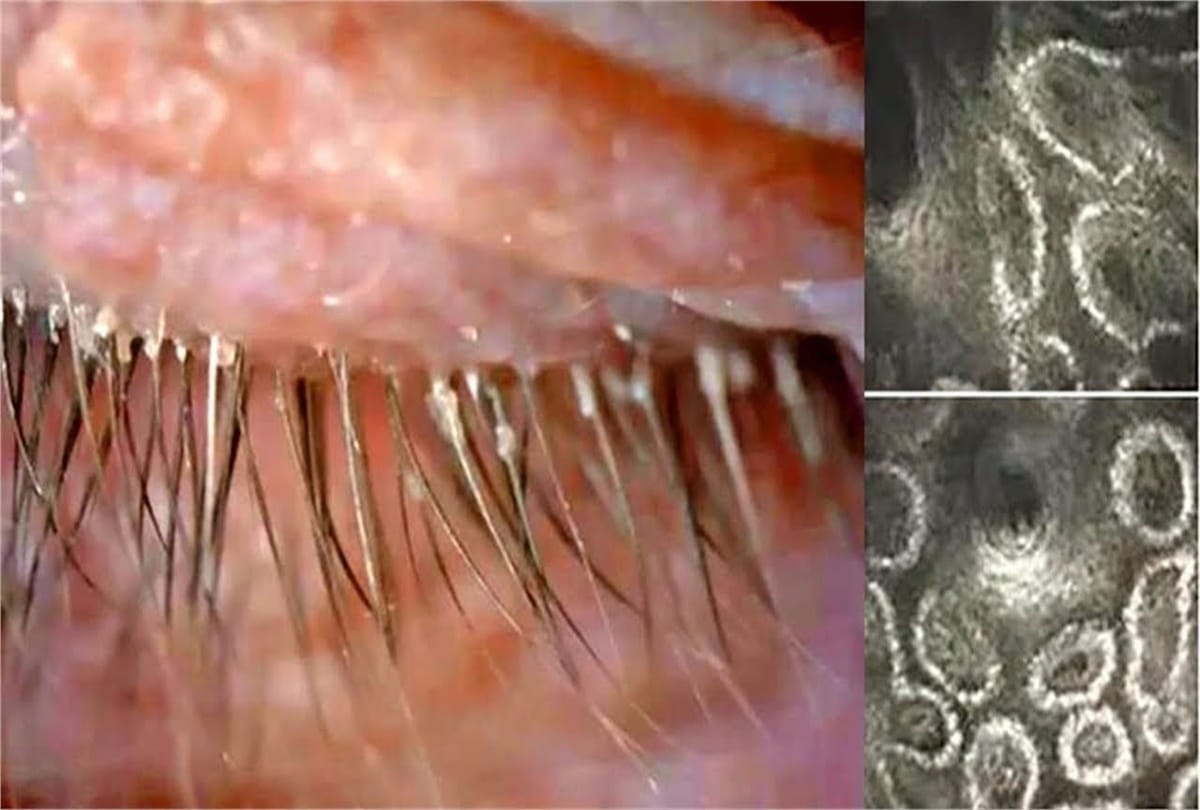 Fourteen worms found in a woman eye