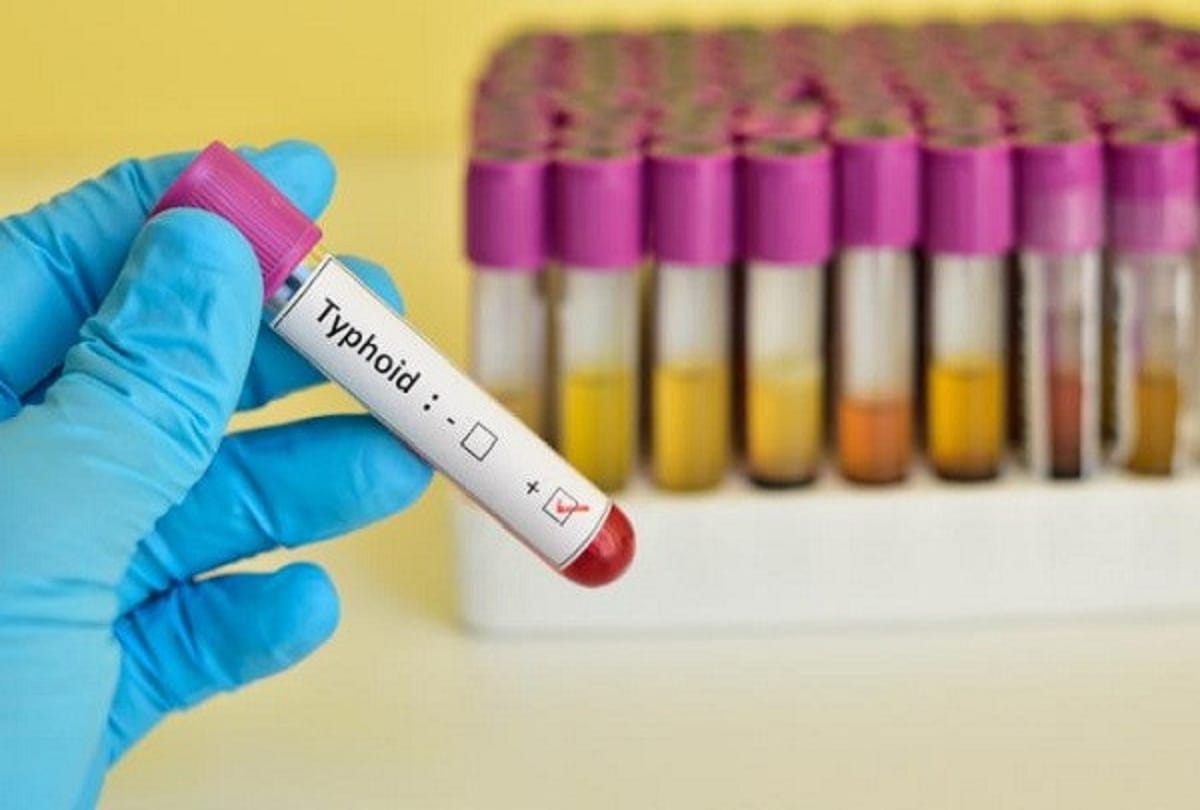now typhoid test available in affordable price 