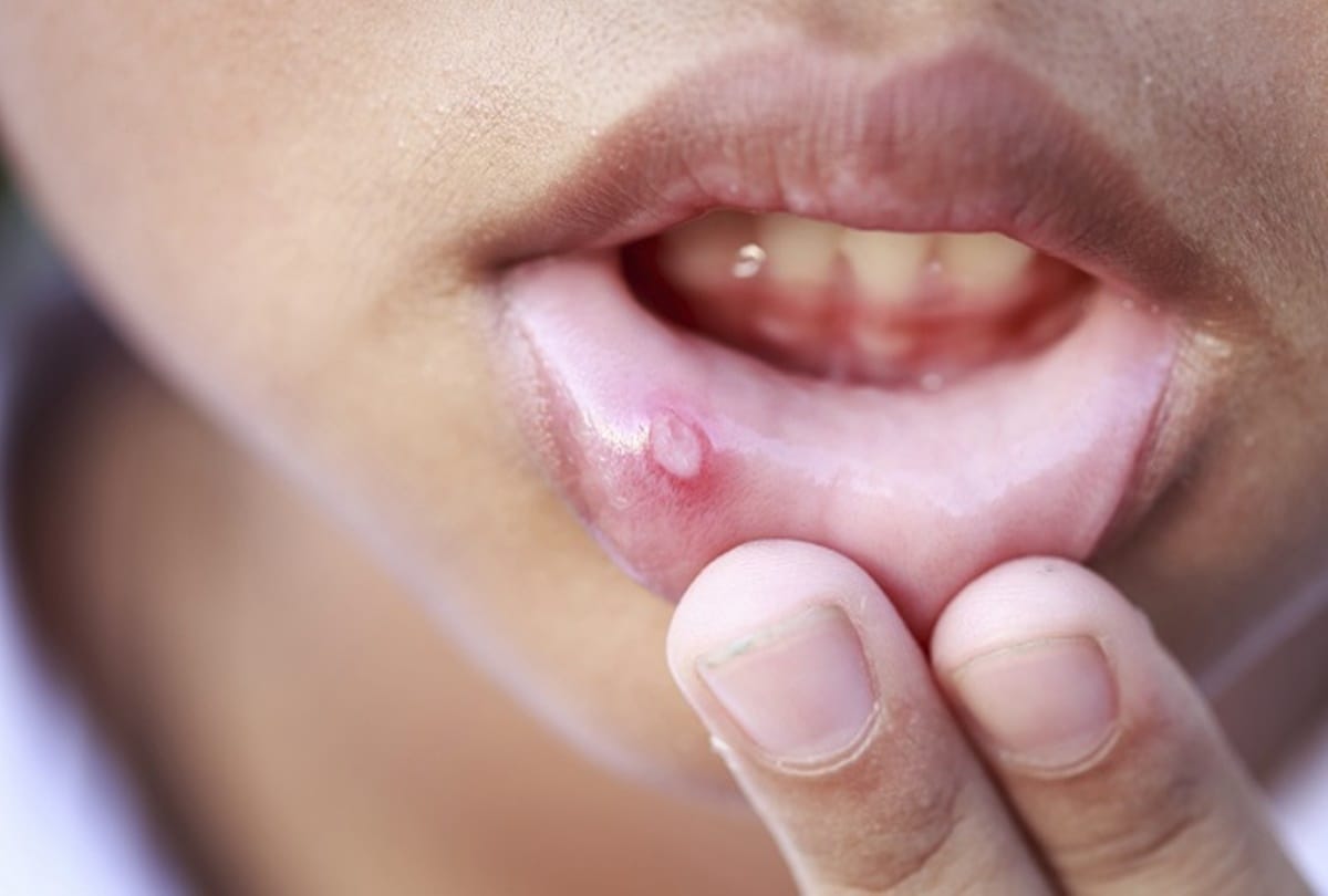 eat this things in mouth ulcer in hindi