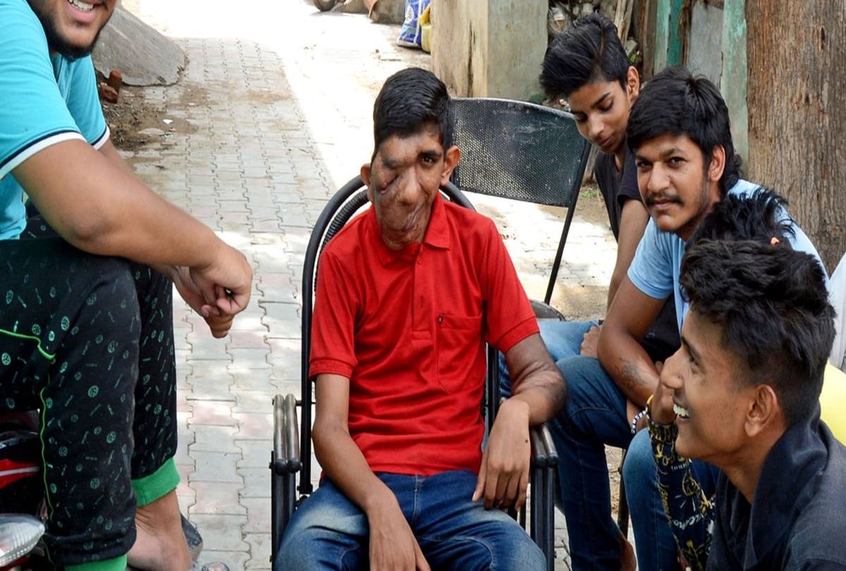 Indian teen suffering from skin rare disease
