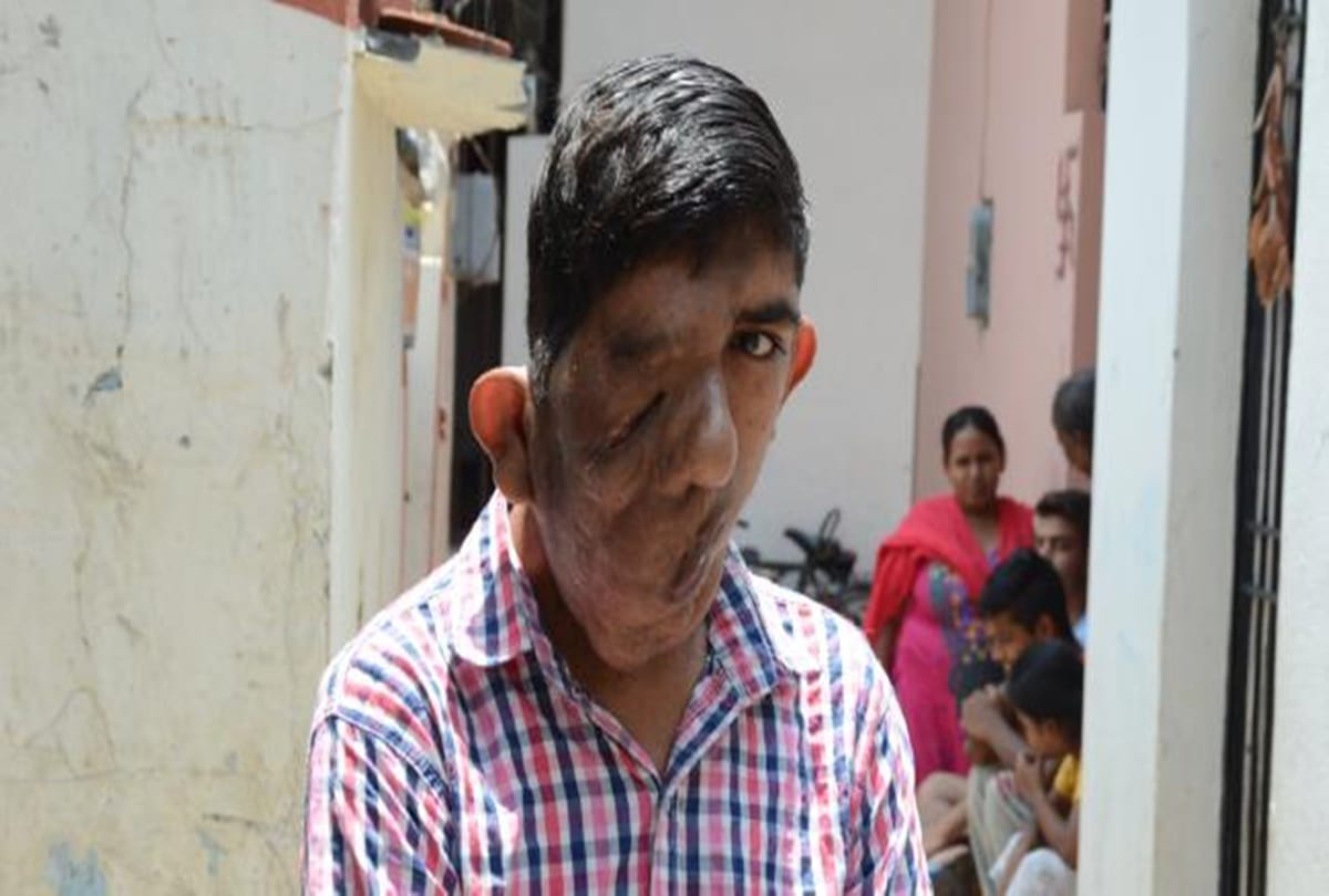 Indian teen suffering from skin rare disease