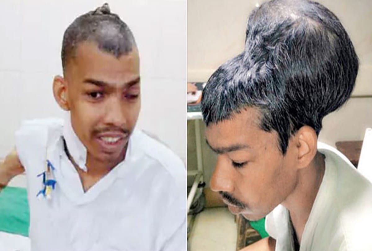 Mumbai doctors remove worlds biggest tumor from a man head 