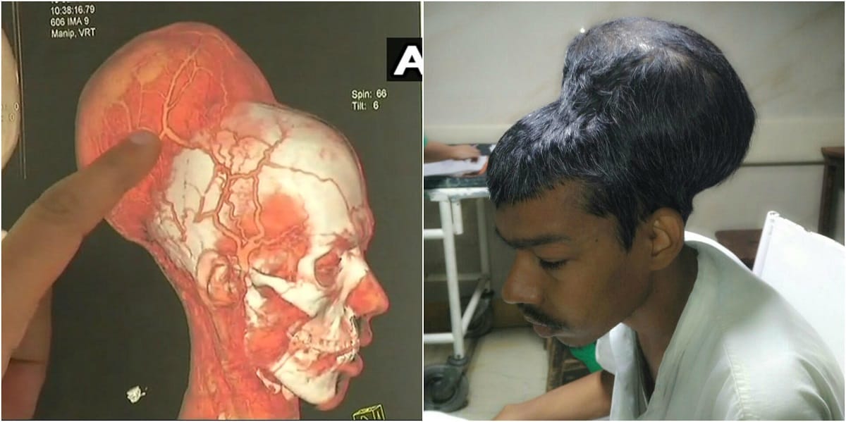 Mumbai: almost two kg Tumor removed by doctor on a patient's head at Nair Hospital