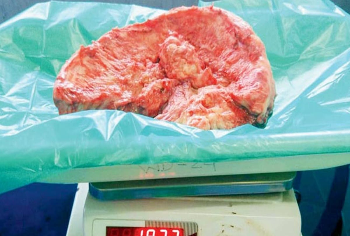 Mumbai doctors remove worlds biggest tumor from a man head 