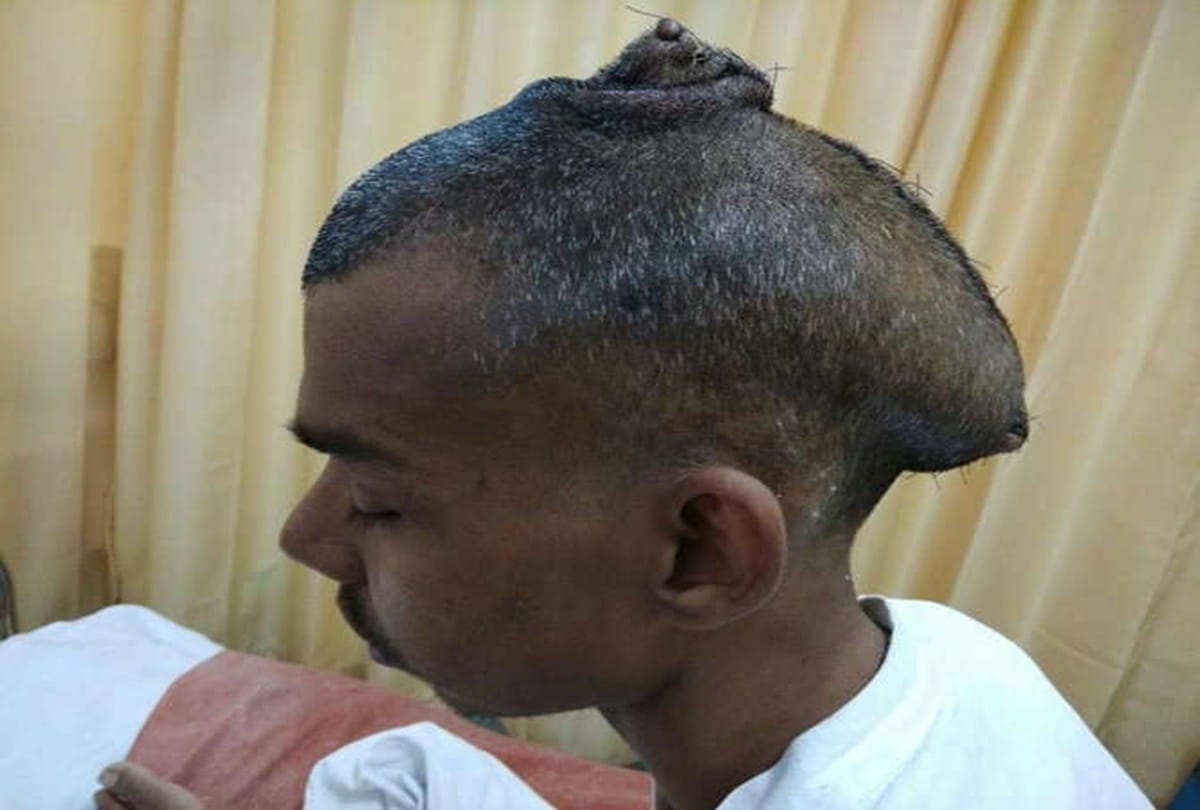 Mumbai doctors remove worlds biggest tumor from a man head 