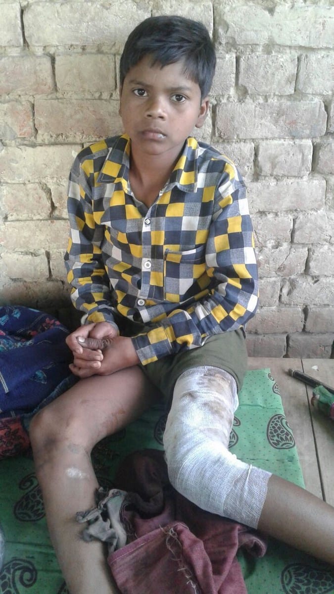 जेब में रखे मोबाइल फोन की बैट्री फटी, किशोर जख्मी