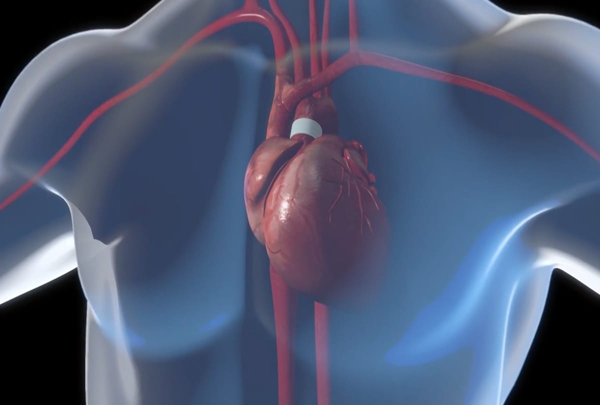 Do You Know If Heart pumps blood out of the body then what will happen