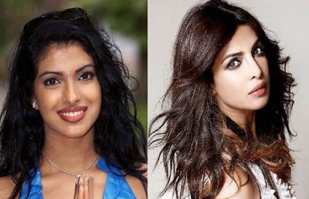 Not only sridevi these five Celebrities also turned Beautiful After Plastic Surgery