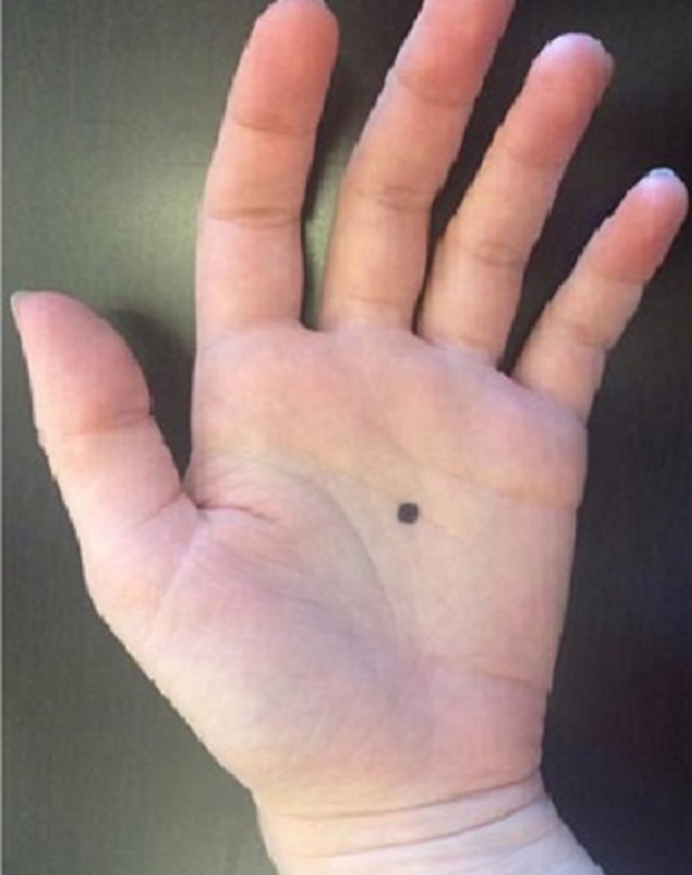palmistry astrology know mole sign significance in human body