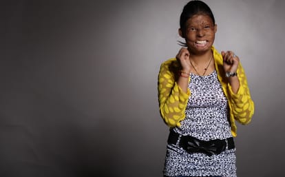 Women's day 2018- acid attack fighter Rupa Selected for Stree Shakti Puraskar