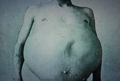 The man who did not poop for thirteen years