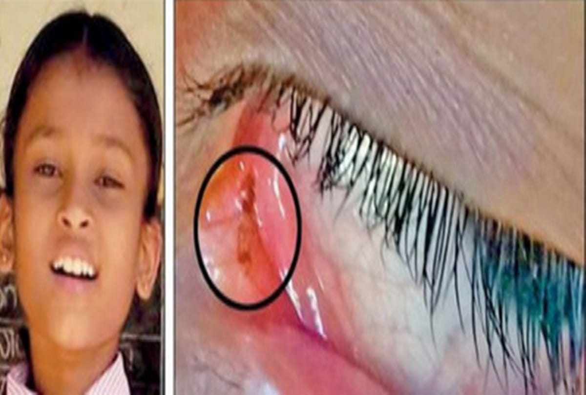 Dead ants found in Kannada girls eyes
