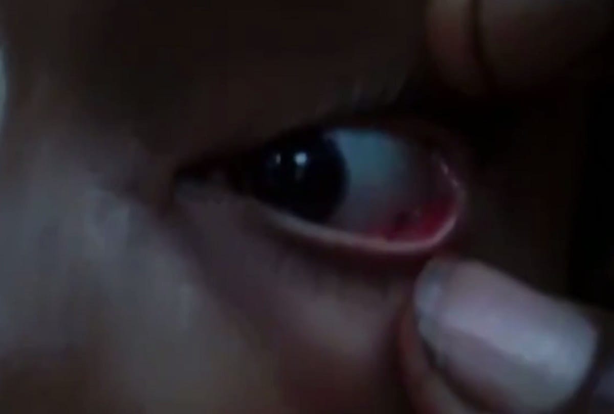Dead ants found in Kannada girls eyes