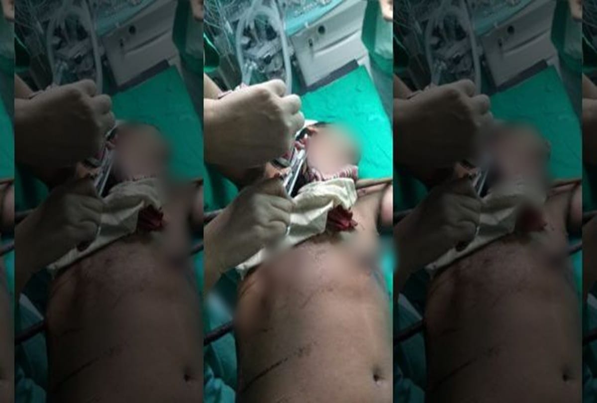 After five hours operation four feet long rod removed from the body of a person