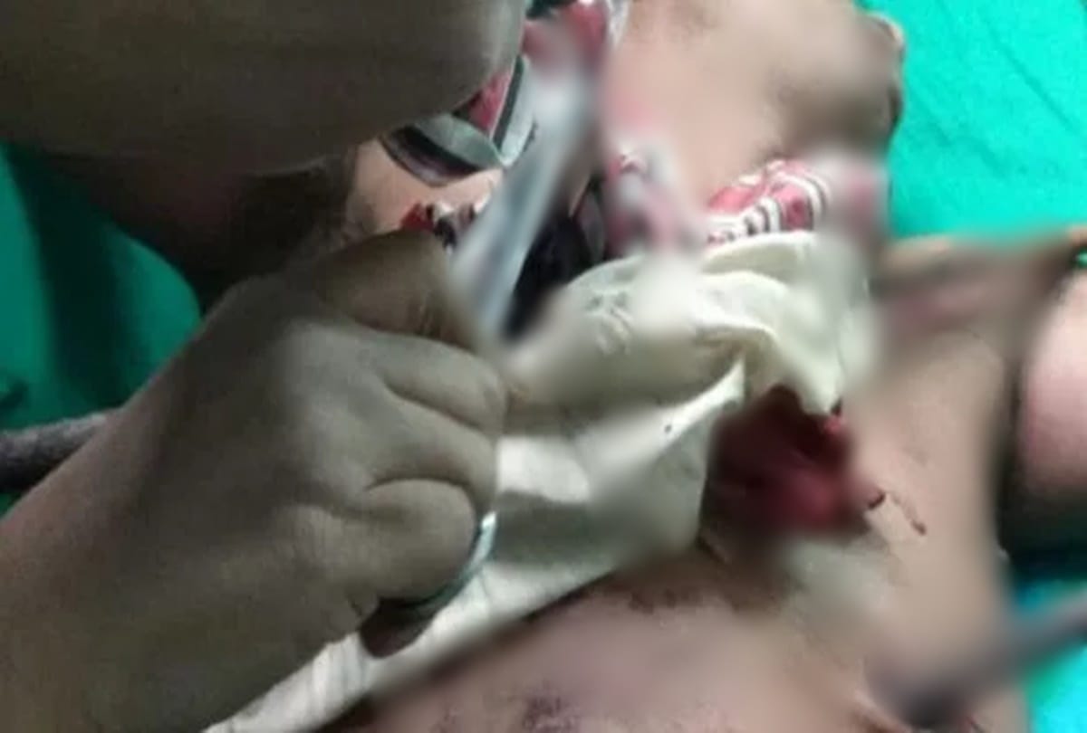 After five hours operation four feet long rod removed from the body of a person