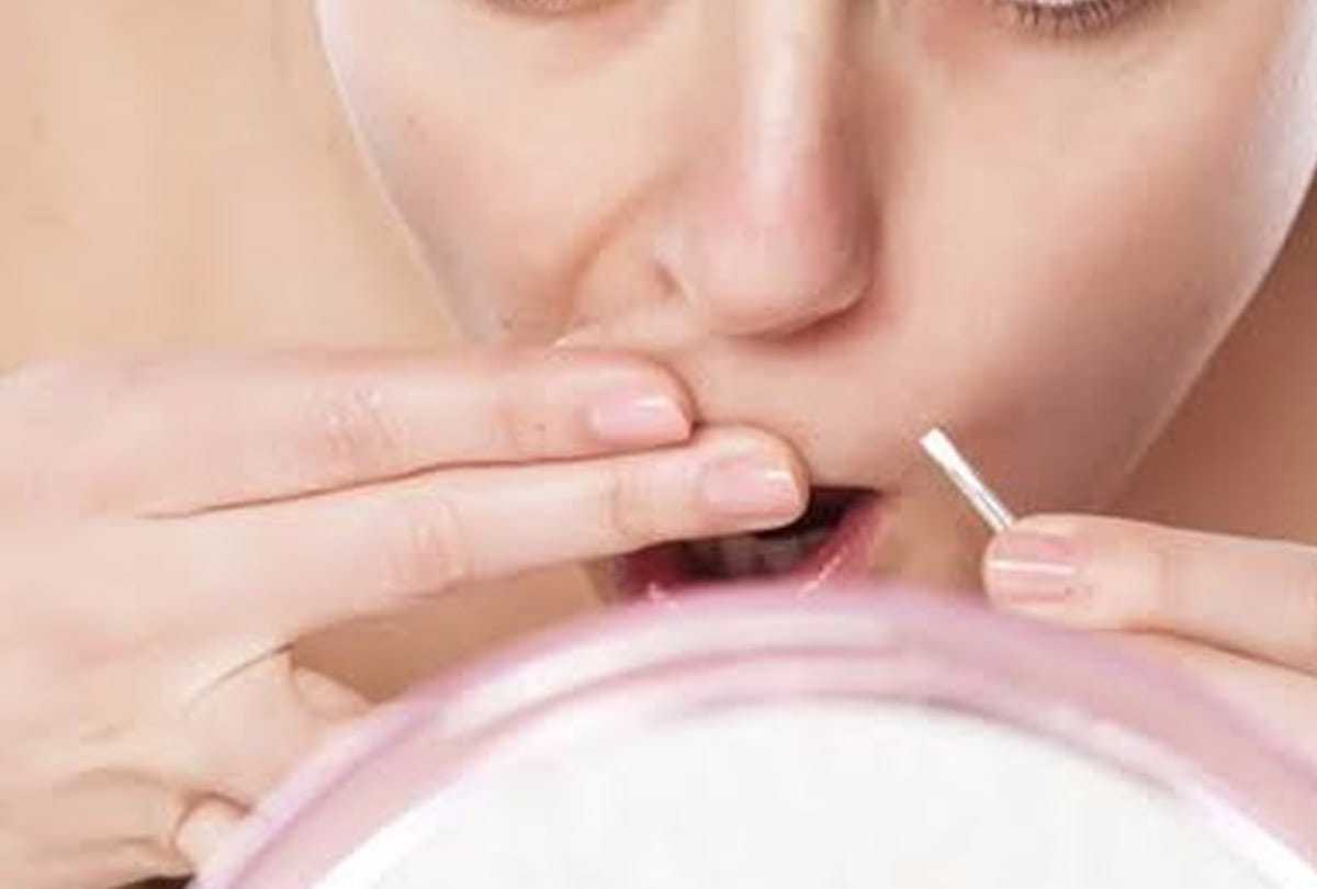 Beard and whiskers in girls due to indiscriminate use of creams