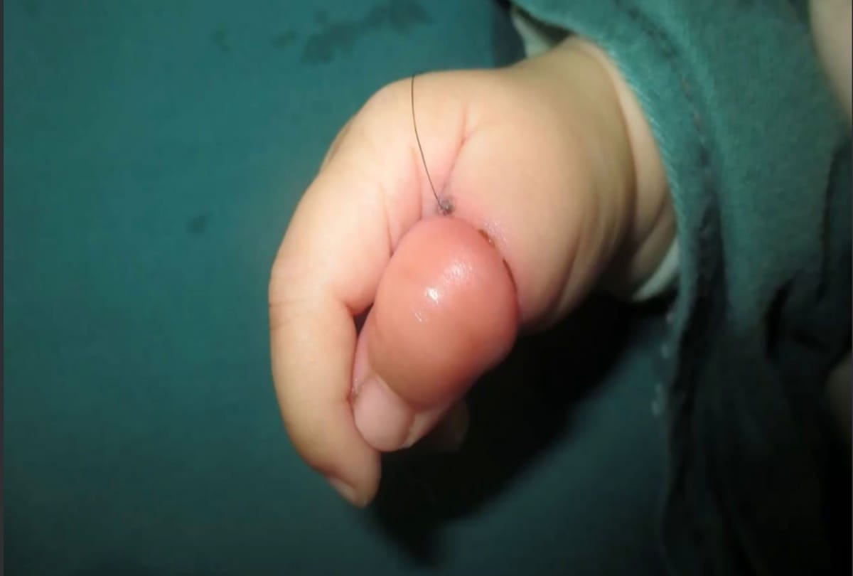 Infant Girl Nearly Loses Thumb Because Of Mums Hair in china