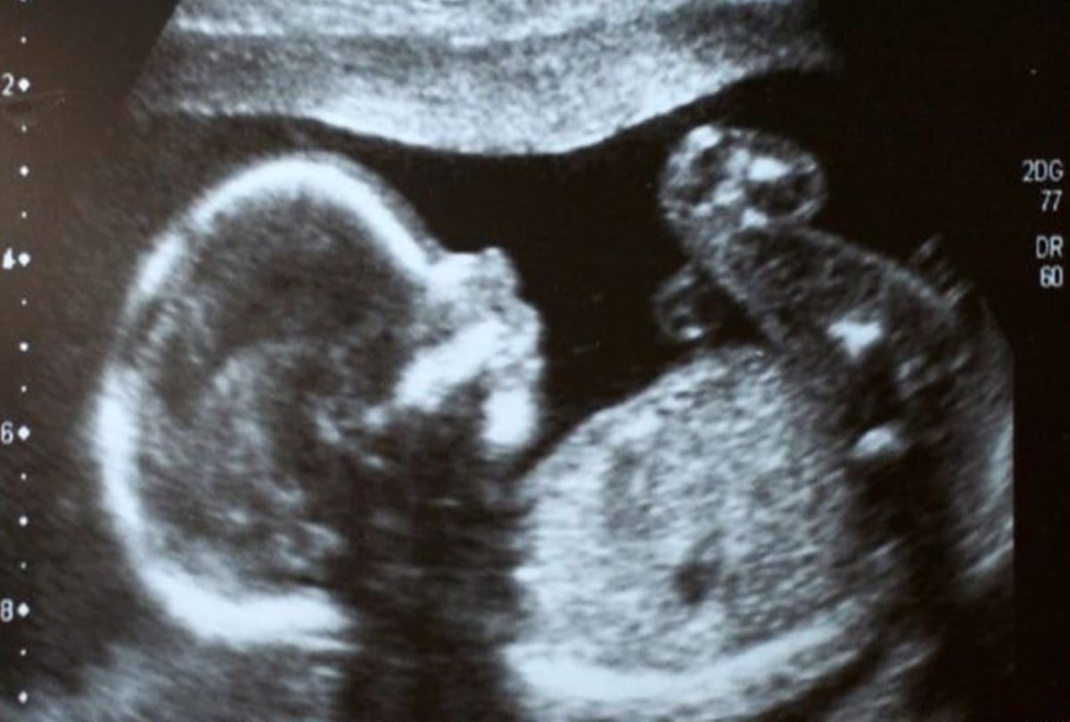 COVID-19 during pregnancy could cause preterm birth Lancet study claims