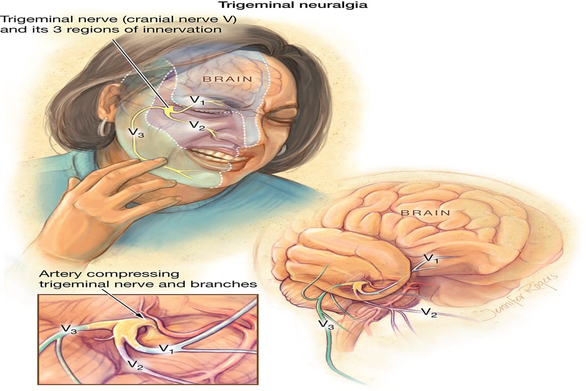 salman khan has suffered painful disease called trigeminal neuralgia