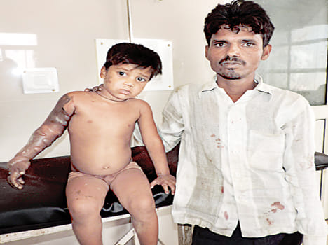 Put hot oil on the child in the land dispute, scorching
