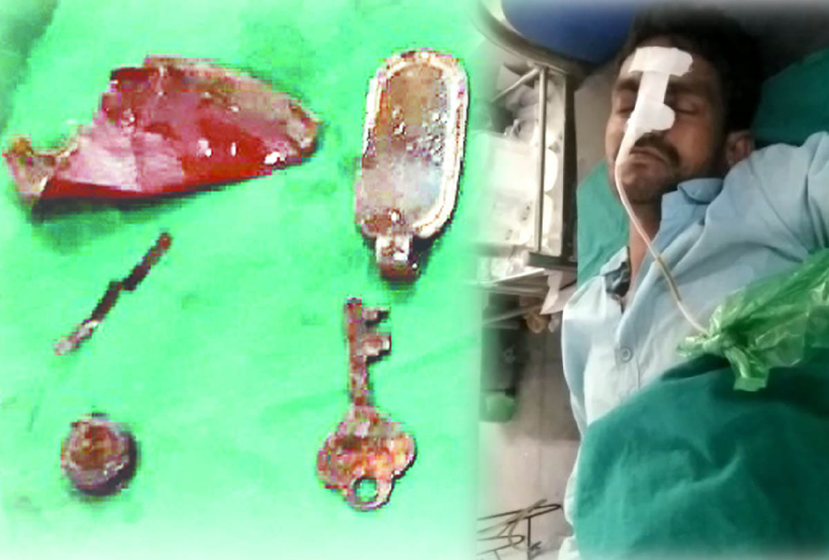 key nail and screw came out of stomach in surgery