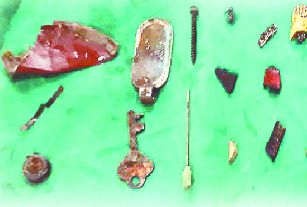 key nail and screw came out of stomach in surgery