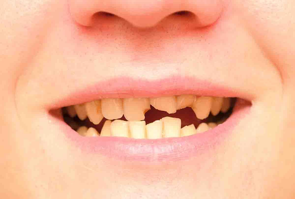Broken teeth will be added again