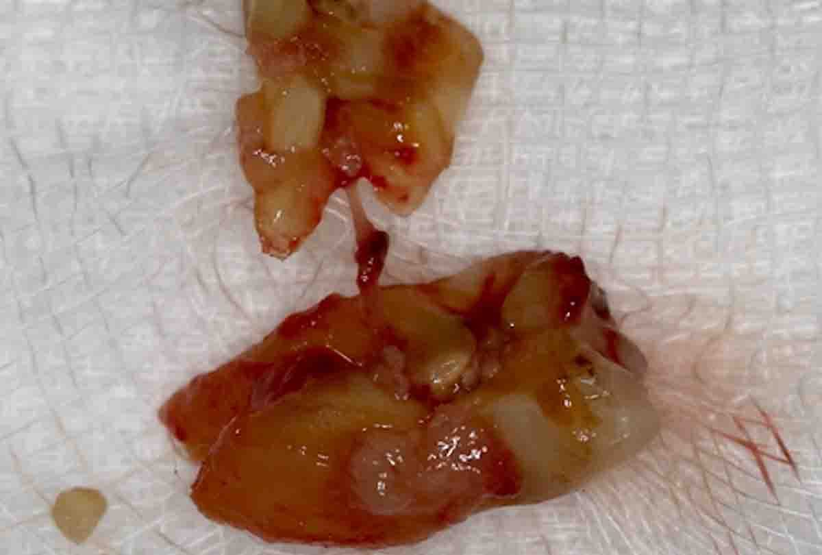 Broken teeth will be added again