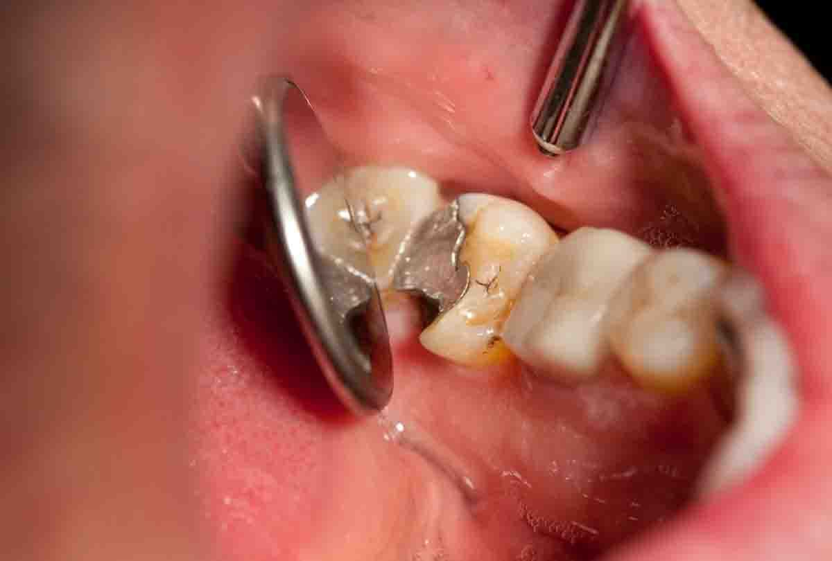 Broken teeth will be added again