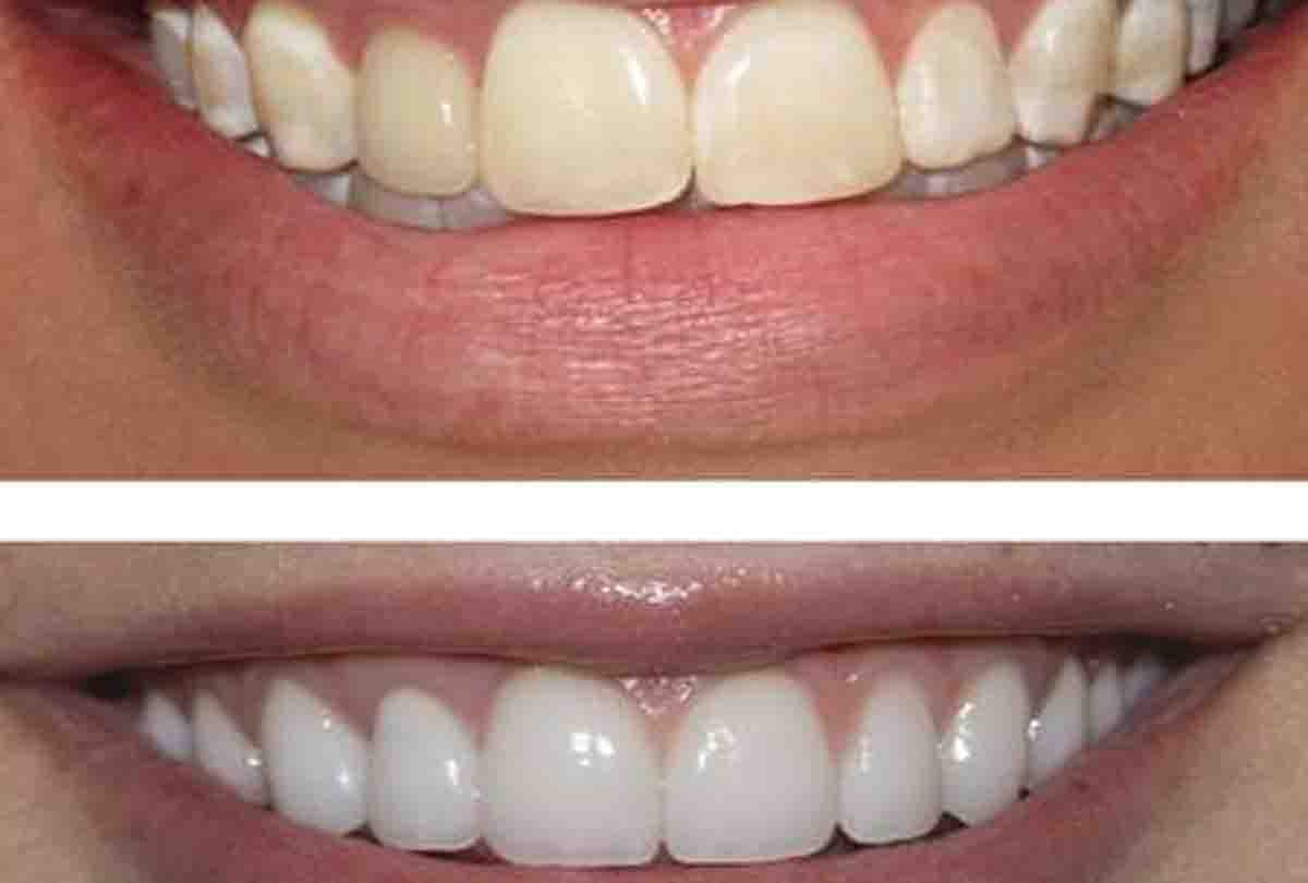Broken teeth will be added again