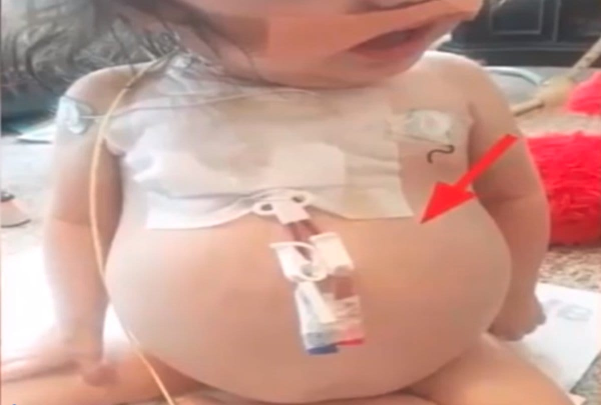 Due to rare genetic disorder little girl look like pregnant