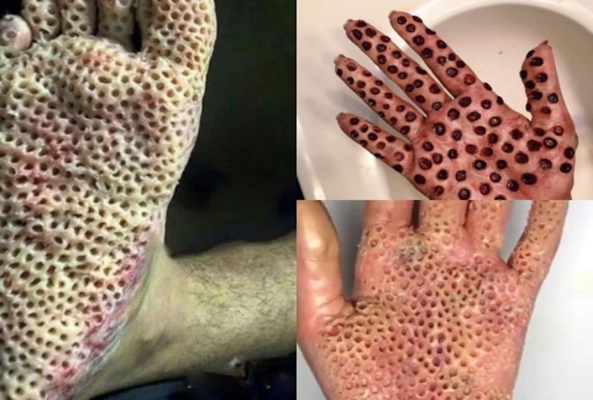 These Pictures showing phobia which called Triphophobia 