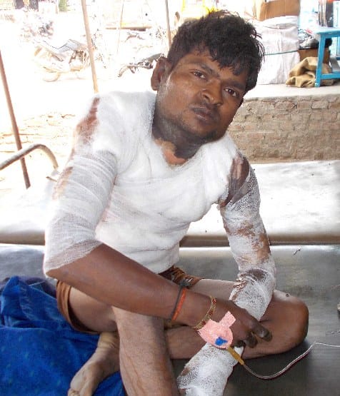 youth burnt by relatives by kerosene oil