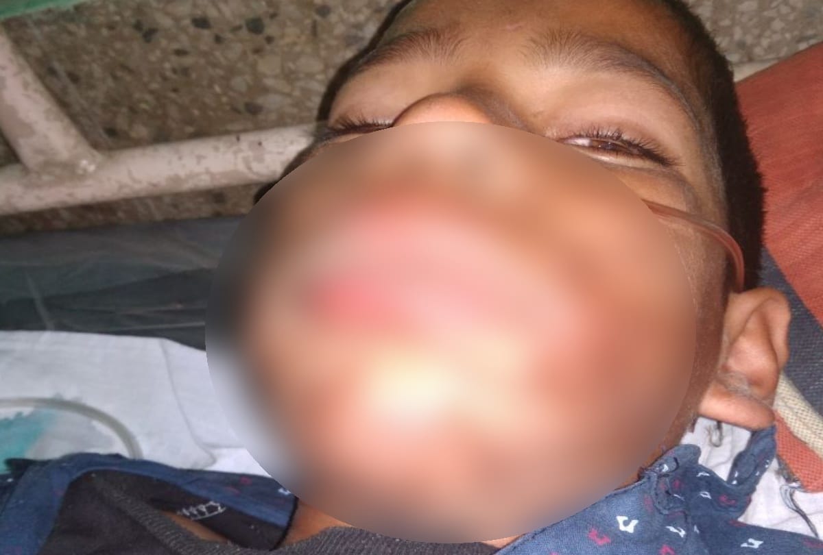 Man pours acid in mouth of 11 year old nephew Mandi himachal pradesh