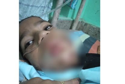 Man pours acid in mouth of 11 year old nephew Mandi himachal pradesh