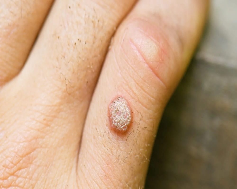 best home remedies to remove warts from face and body