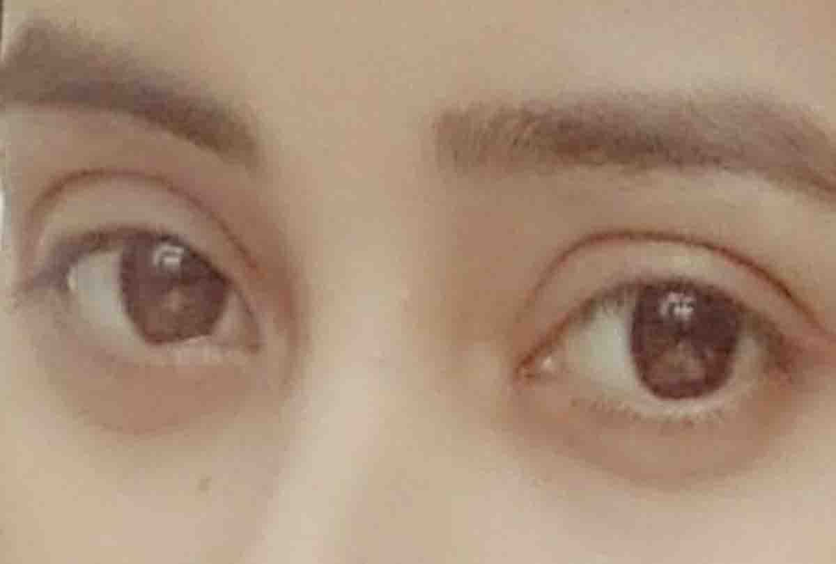 Eye allergies due to temperature rise