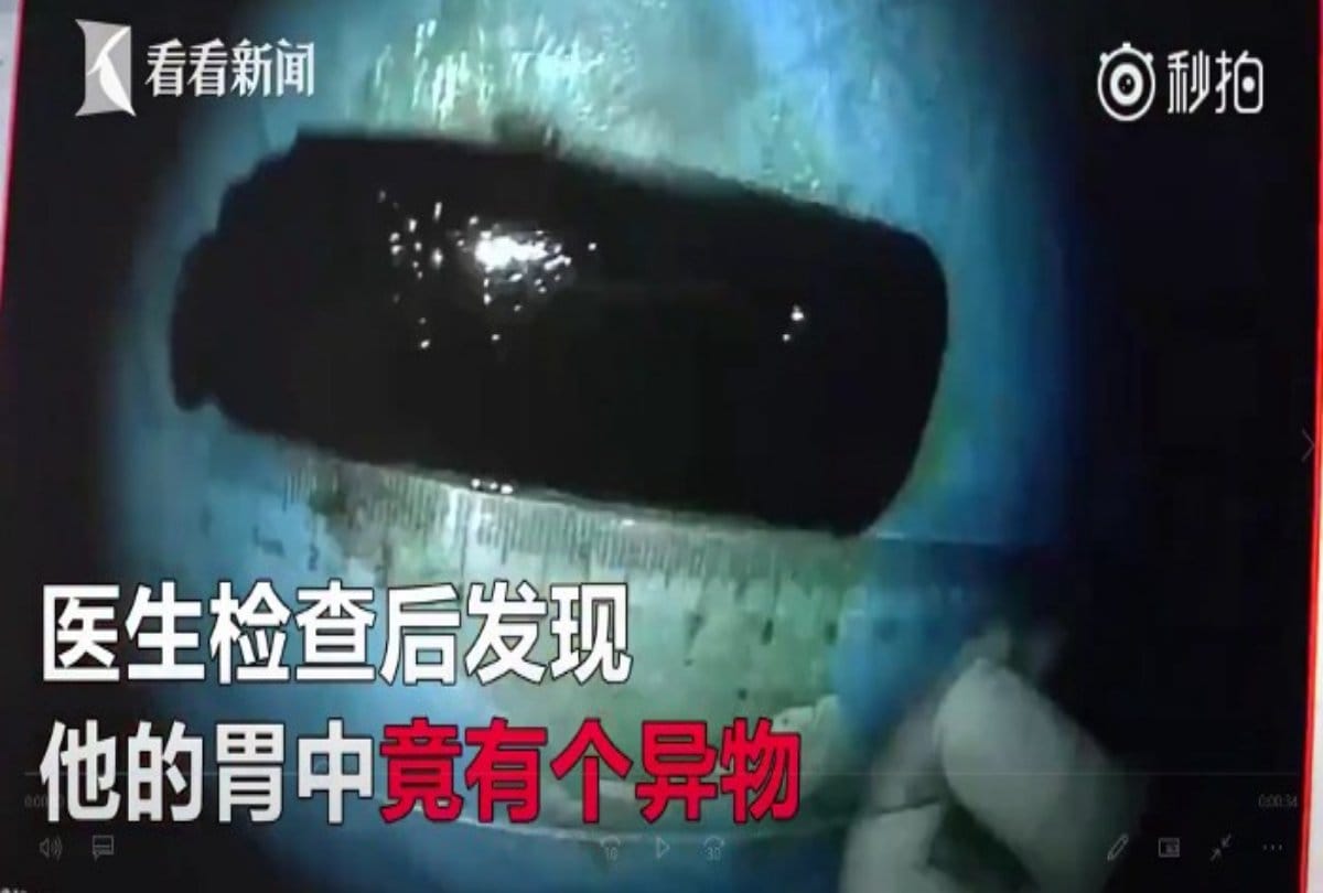 lighter removed from Chinese man stomach after Operation
