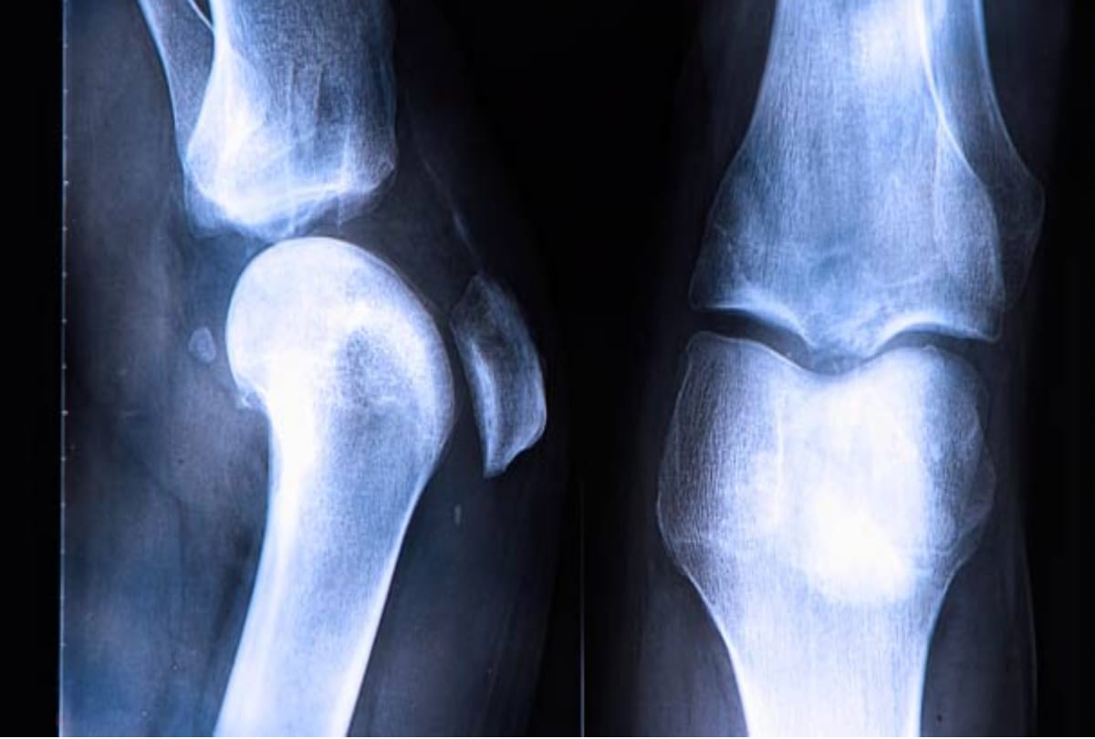 modafinil medicine is harmful for bones