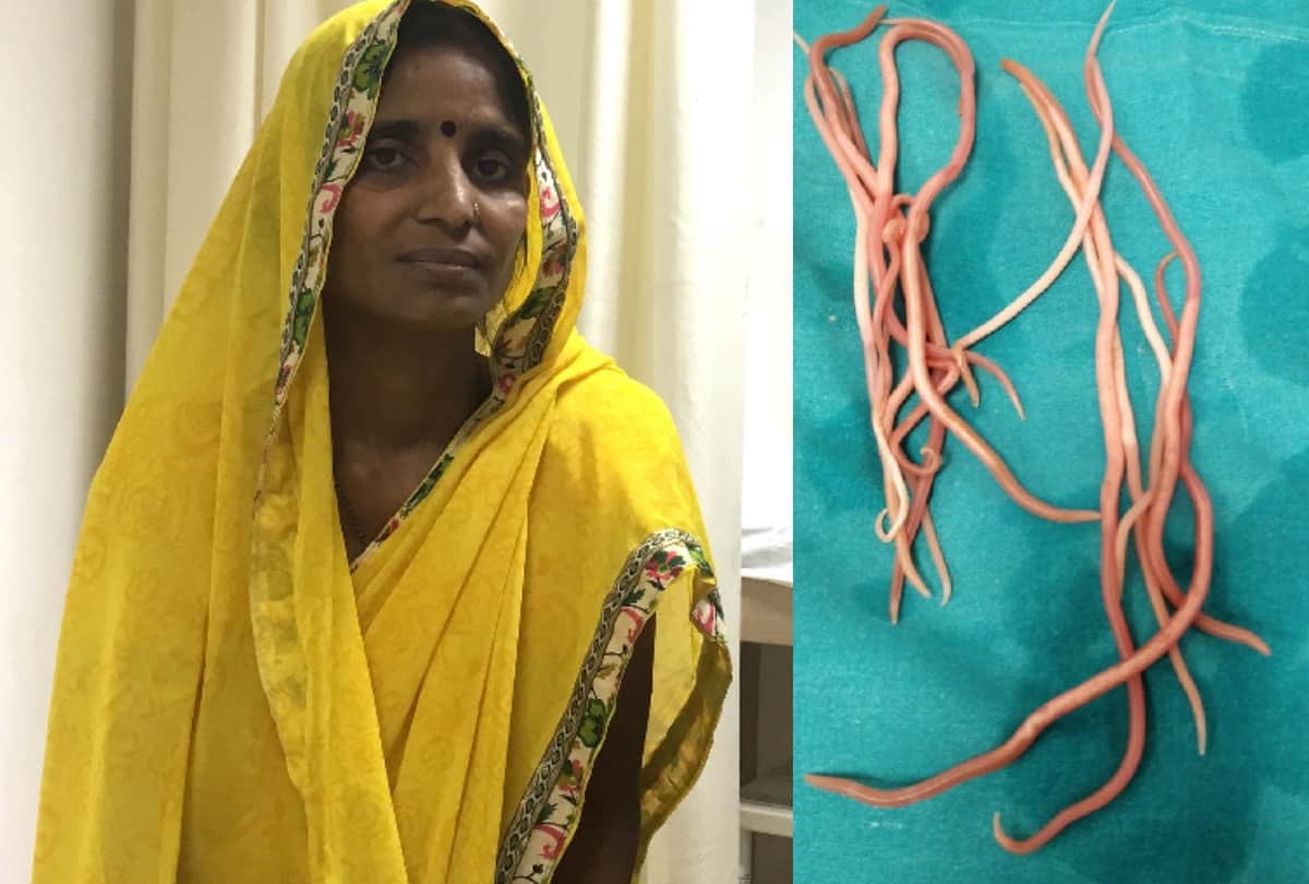 fourteen live round worm took out from bile duct of a woman in delhi by doctors
