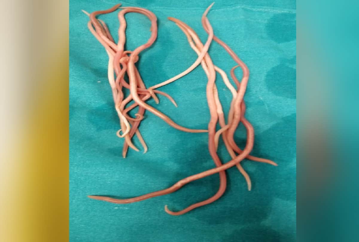 fourteen live round worm took out from bile duct of a woman in delhi by doctors