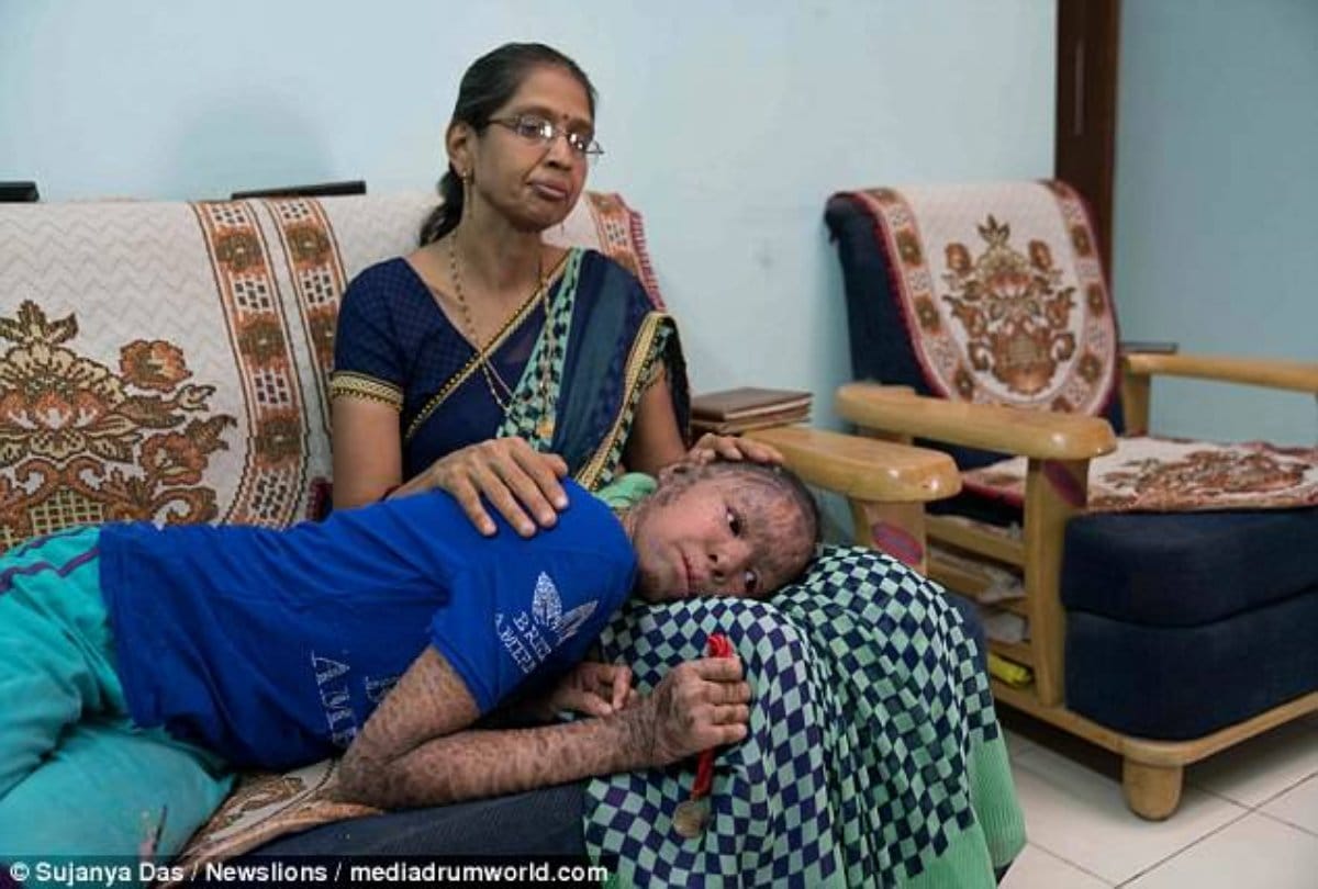 Two sister Body turns in to Snack in indore reason is lameller ichthyosis diseases
