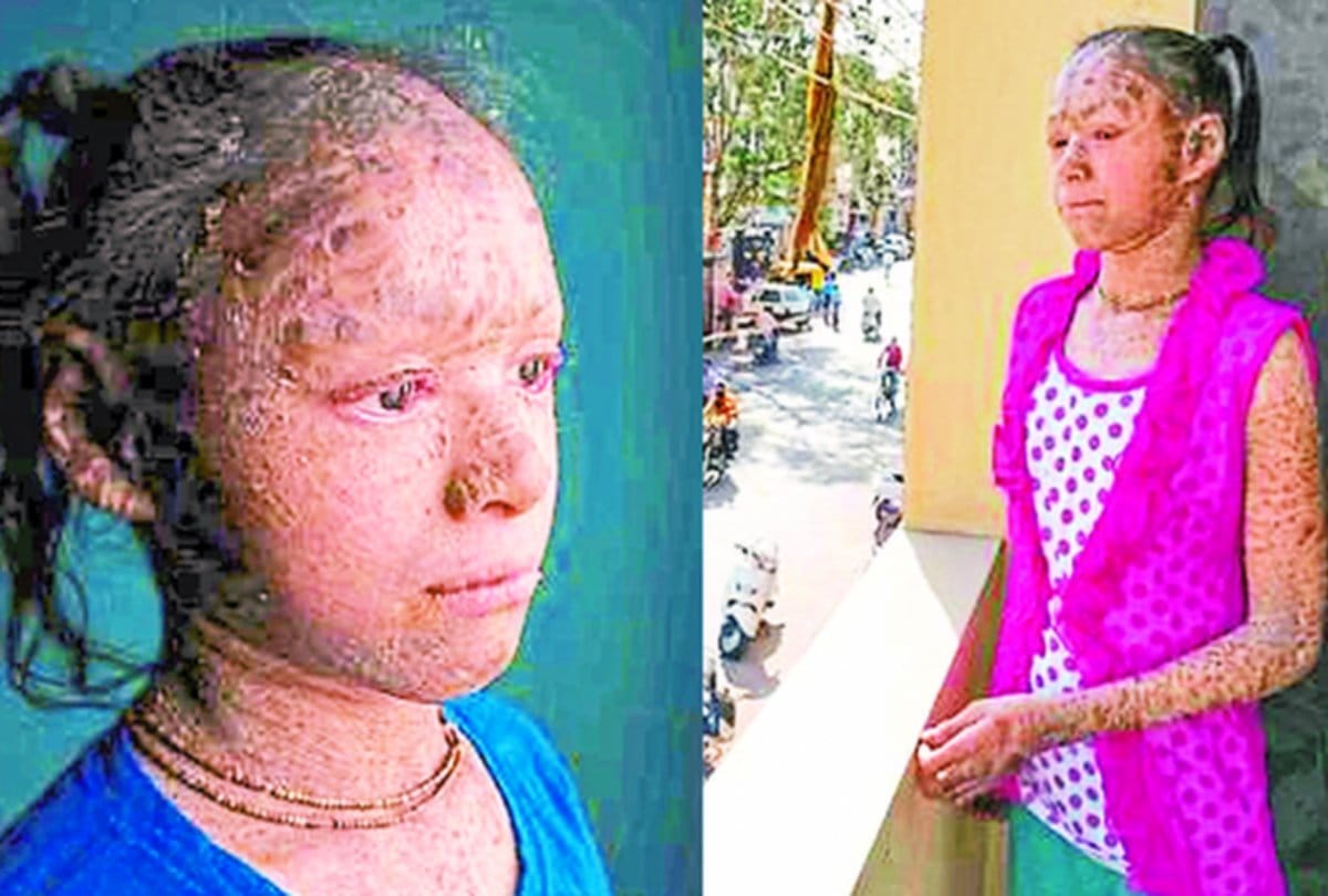 Two sister Body turns in to Snack in indore reason is lameller ichthyosis diseases