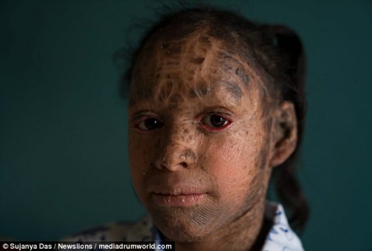 Two sister Body turns in to Snack in indore reason is lameller ichthyosis diseases